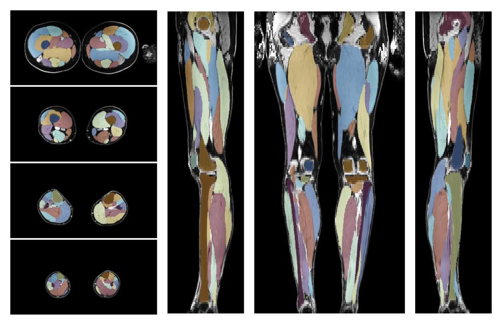 Overlay of automated muscle segmentation labels on dixon water image.